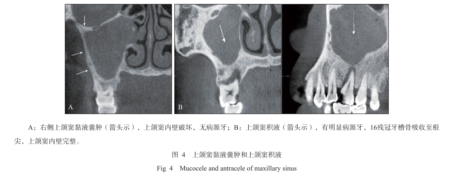 上颌窦黏液囊肿