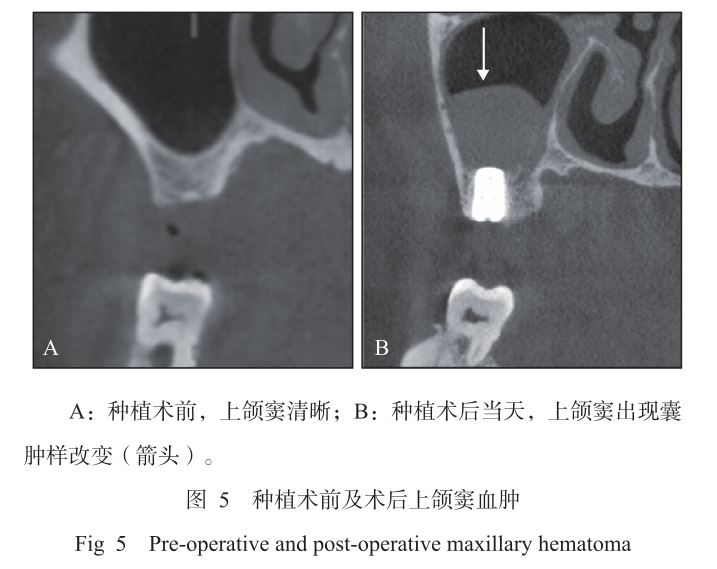 术后上颌窦内血肿